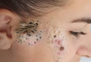 Dr. Blackhead Extractions EP : 04 – REMOVAL PIMPLE