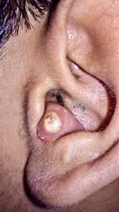 Dr. Blackhead Extractions EP : 03 – REMOVAL PIMPLE