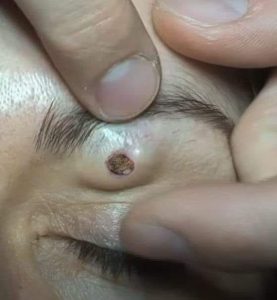 Dr. Blackhead Extractions EP : 09 – BEST TIPS Dr. Blackhead Extractions EP : 09 – BEST TIPS