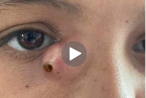 Dr. Blackhead Extractions EP: 05 – REMOVAL PIMPLE