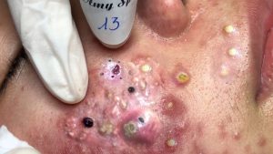 OMG What is acne?