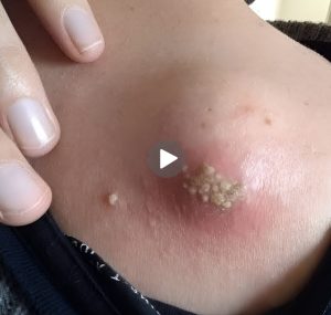 Dr. Blackhead Extractions EP : 08 – BEST TIPS Dr. Blackhead Extractions EP : 08 – BEST TIPS