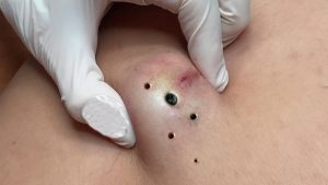 Where do acne scars come from?