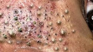 When does acne start to scar?