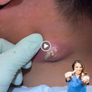 DR. Blackhead Extractions EP : 10 – BEST TIPS DR. Blackhead Extractions EP : 10 – BEST TIPS
