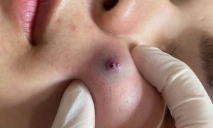 Active acne breakouts [ Dr-Pimple Propper]