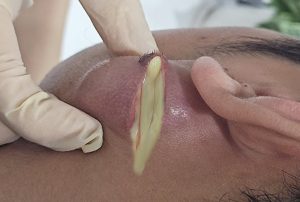 Acne scars are evidence –  Dr Sandra Lee