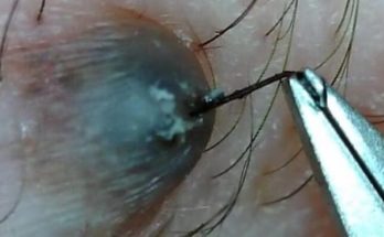 Dr. Blackhead Extractions EP:592 – REMOVAL PIMPLE 