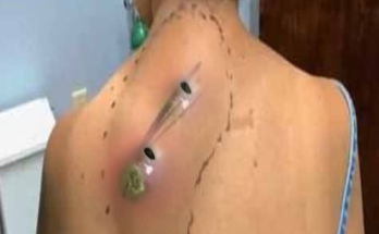 Dr. Blackhead Extractions EP:610 – REMOVAL PIMPLE 