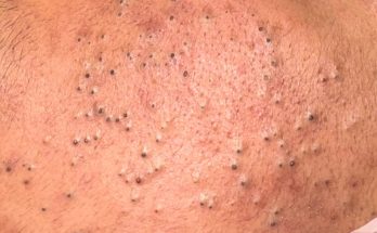 Dr. Blackhead Extractions EP:612 – REMOVAL PIMPLE