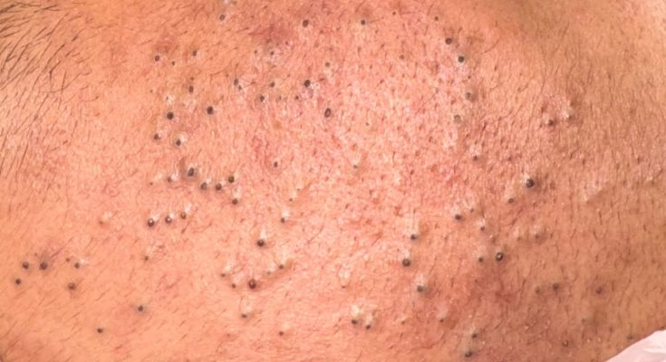 Dr. Blackhead Extractions EP:612 – REMOVAL PIMPLE