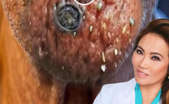 Dr. Blackhead Extractions EP:602 Dr. Blackhead Extractions EP:602