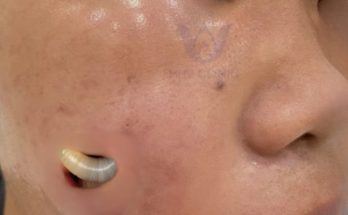Dr. Blackhead Extractions EP:613 – REMOVAL PIMPLE 