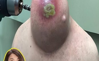 Dr. Blackhead Extractions EP:615 – REMOVAL PIMPLE