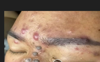Dr. Blackhead Extractions EP:616 – REMOVAL PIMPLE 