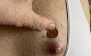 Dr. Blackhead Extractions EP:618 – REMOVAL PIMPLE Dr. Blackhead Extractions EP:618 – REMOVAL PIMPLE