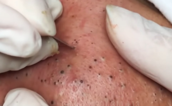 How to Safely Remove Blackheads from Your Face