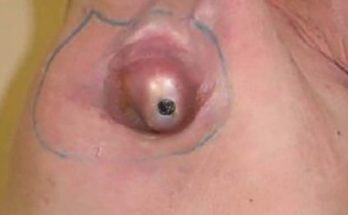 Dr. Blackhead Extractions EP:619 – REMOVAL PIMPLE 