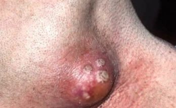 Dr. Blackhead Extractions EP:601
