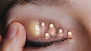 How to Safely Clean Blackheads: A Dermatologist-Approved Guide