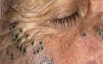 Dr. Blackhead Extractions EP:600