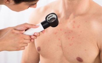 Chest acne