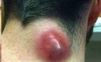 Dr. Blackhead Extractions EP:603 – REMOVAL PIMPLE
