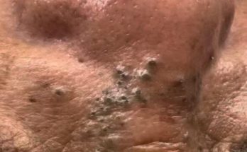 Dr. Blackhead Extractions EP:604 – REMOVAL PIMPLE