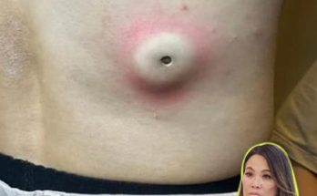 Dr. Blackhead Extractions EP:606 – REMOVAL PIMPLE