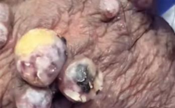 Dr. Blackhead Extractions EP:608 – REMOVAL PIMPLE 