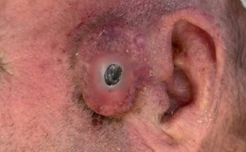 Dr. Blackhead Extractions EP:620 – REMOVAL PIMPLE