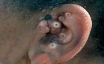 Dr. Blackhead Extractions EP:621 – REMOVAL PIMPLE