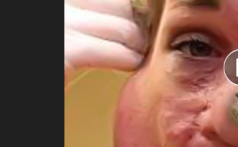Dr. Blackhead Extractions EP:622 – REMOVAL PIMPLE