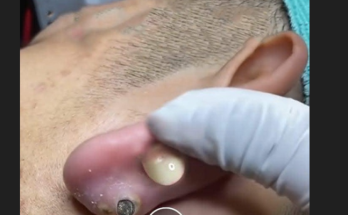 Dr. Blackhead Extractions EP:623 – REMOVAL PIMPLE