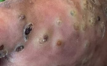 Dr. Blackhead Extractions EP:624 – REMOVAL PIMPLE