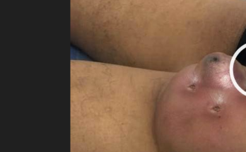 Dr. Blackhead Extractions EP:635 – REMOVAL PIMPLE