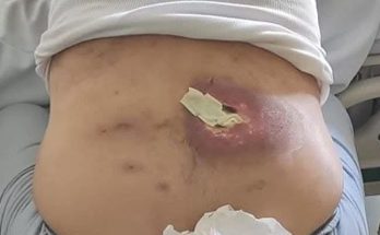Dr. Blackhead Extractions EP:625 – REMOVAL PIMPLE