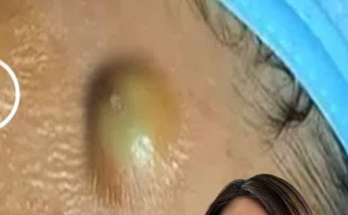 Dr. Blackhead Extractions EP:626 – REMOVAL PIMPLE