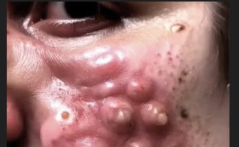 Blackhead Extractions EP:01