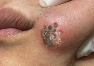 Blackhead Extractions EP: 02