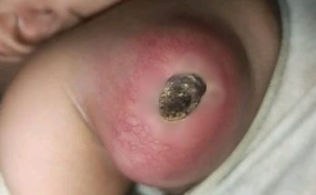 Blackhead Extractions EP: 03