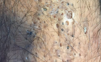 Blackhead Extractions EP: 04