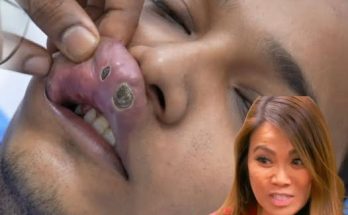Blackhead Extractions EP: 05