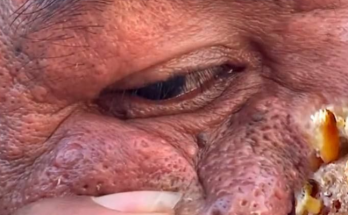 Blackhead Extractions EP:06