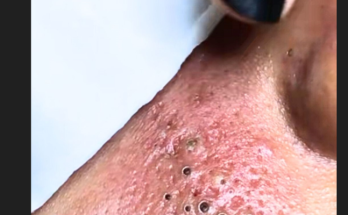 Blackhead Extractions EP: 07