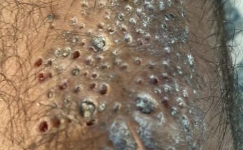 Blackhead Extractions EP:08