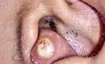 Blackhead Extractions EP:09 