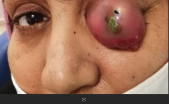 Dr. Blackhead Extractions EP:113