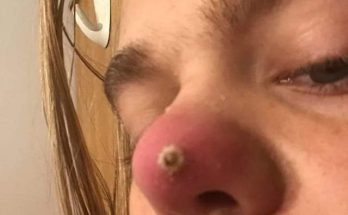 Dr. Blackhead Extractions EP: 33