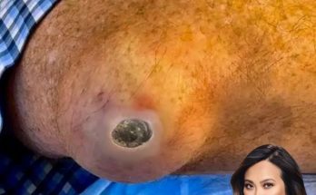 Dr. Blackhead Extractions EP: 32